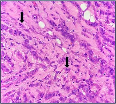 Tumour budding in invasive ductal breast carcinomas: correlation with clinicopathological prognostic parameters and hormone receptor status